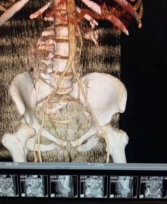 3D vascular dynamic model reconstructed from CT and X-ray